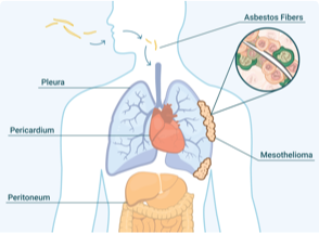 asbestos fibers injested in the body with mesothelioma tumors forming in the lining around the lungs