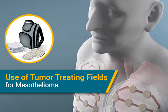 tumor treating fields for mesothelioma