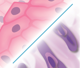 biphasic mesothelioma tumor cells