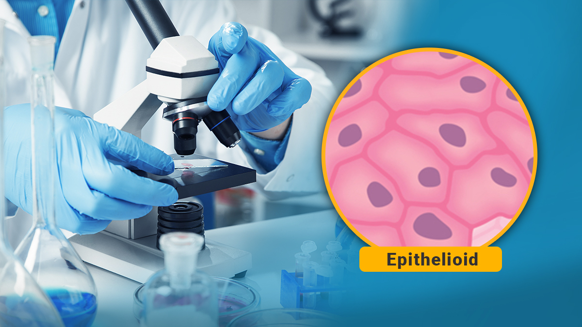 Gorgeous Icd 10 Epithelioid Mesothelioma Photo for Your Screen Gorgeous Icd 10 Epithelioid Mesothelioma Photo for Your Screen