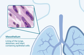 Sarcomatoid Cell Type