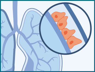 Epithelial cells can transform into sarcomatoid cells when they become cancerous