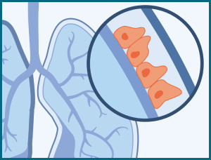 Epithelial cells can transform into sarcomatoid cells when they become cancerous