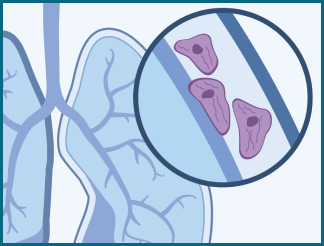 When mesenchymal cells become cancerous, they are called sarcomas