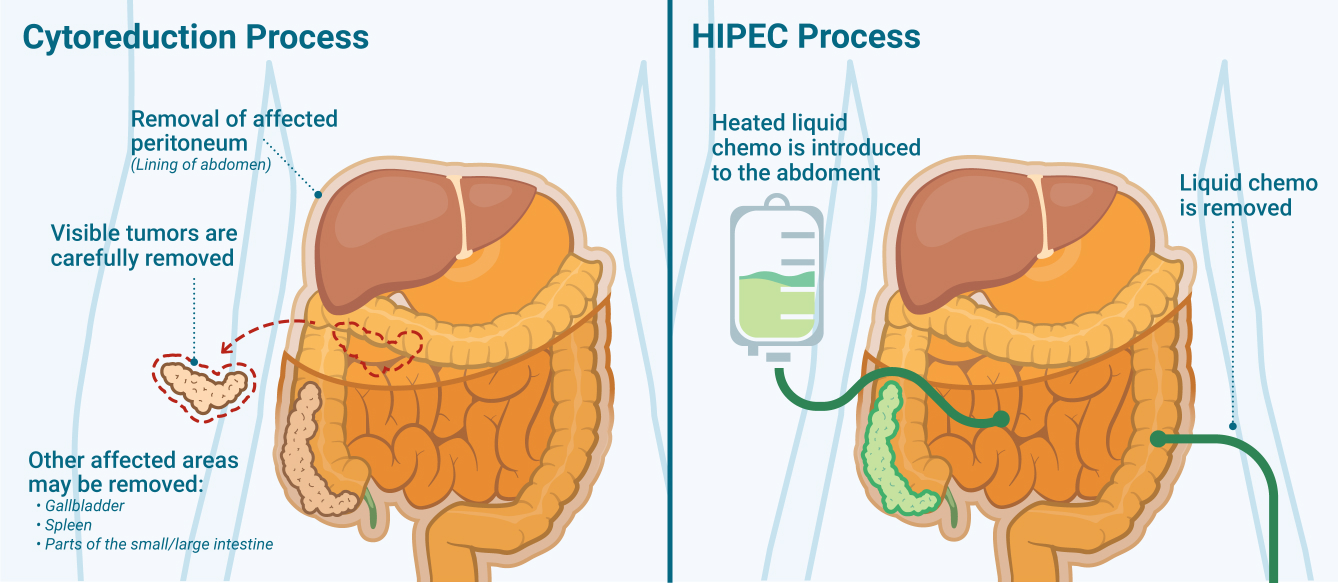 Cytoreducation and HIPEC processes