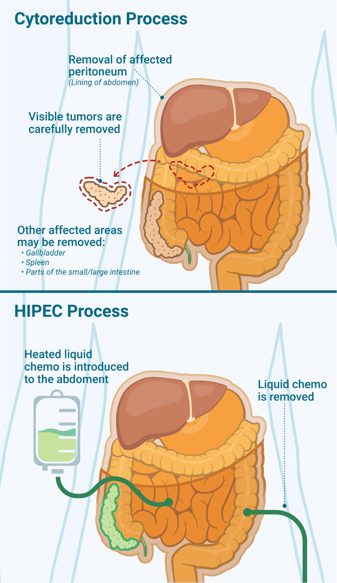 Cytoreducation and HIPEC processes