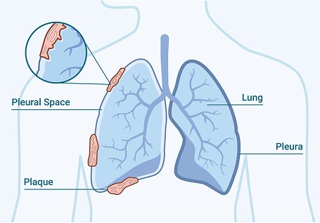 Pleural Plaques