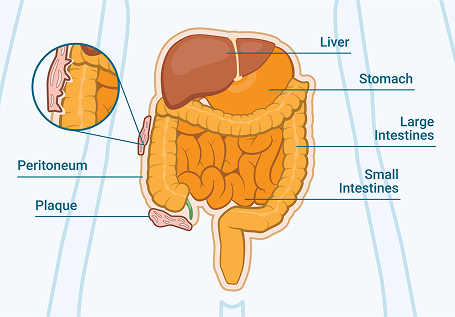 Peritoneal Plaques