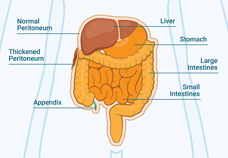 Peritoneal Thickening