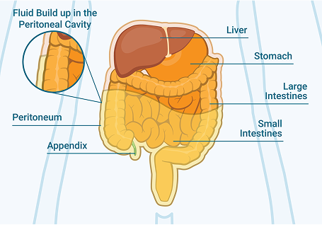 Ascites