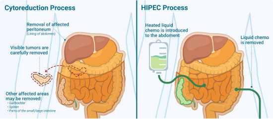 Diagram illustrating the digestion process alongside hyperthermic intraoperative chemotherapy for mesothelioma treatment.