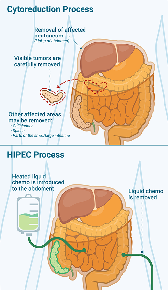 Diagram illustrating the digestion process alongside hyperthermic intraoperative chemotherapy for mesothelioma treatment.