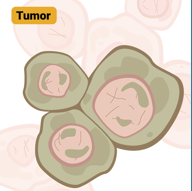 Illustrated depiction of a tumor, showing the TNM system used for cancer staging and assessment.