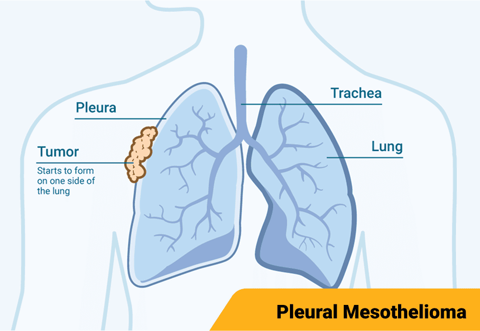 Diagram illustrating stage 1 pleural mesothelioma, highlighting the pleura between the lung and chest wall.