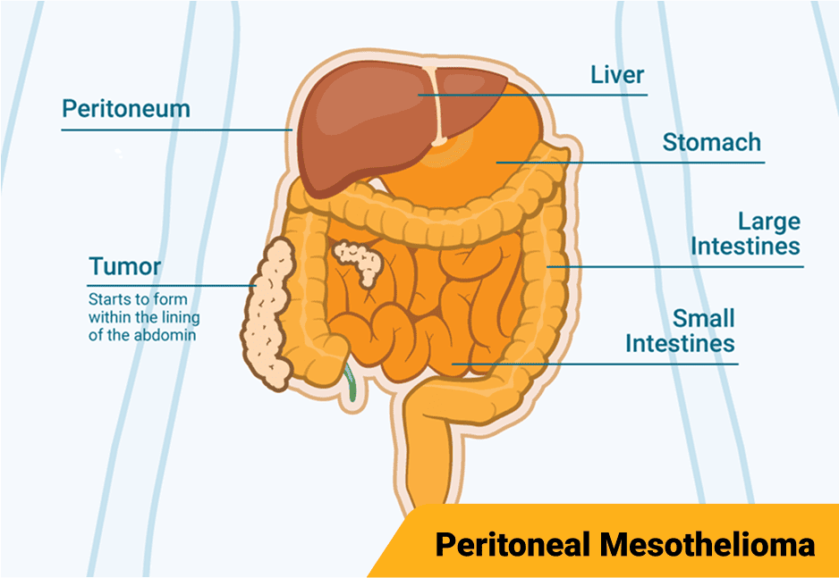 Diagram illustrating Stage 1 peritoneal mesothelioma affecting the peritoneum and a small part of the abdomen