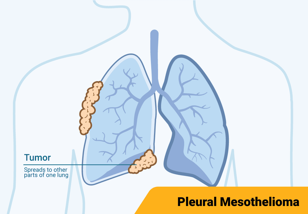 Diagram illustrating stage 2 pleural mesothelioma, highlighting the pleura between the lung and chest wall.