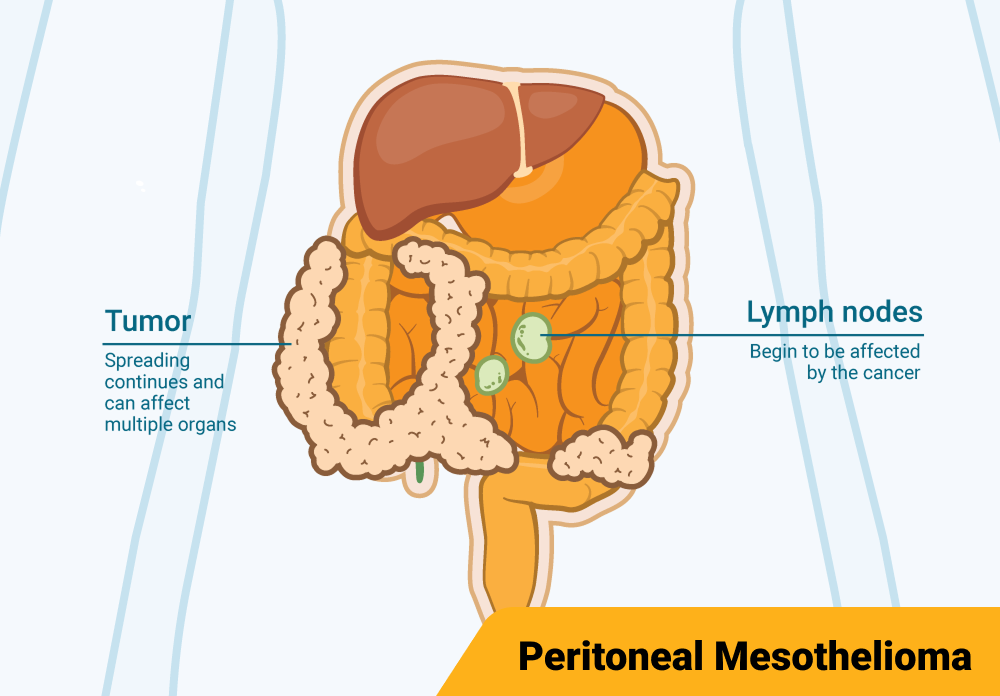 Diagram illustrating Stage 3 peritoneal mesothelioma affecting the peritoneum and a small part of the abdomen