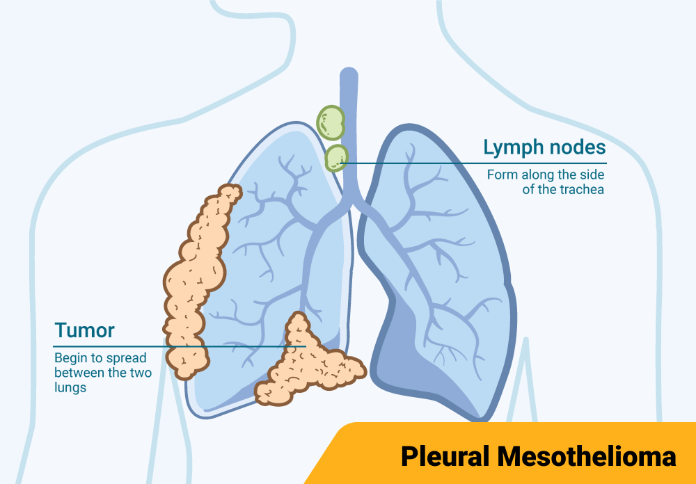 Diagram illustrating stage 3 pleural mesothelioma, highlighting the pleura between the lung and chest wall.