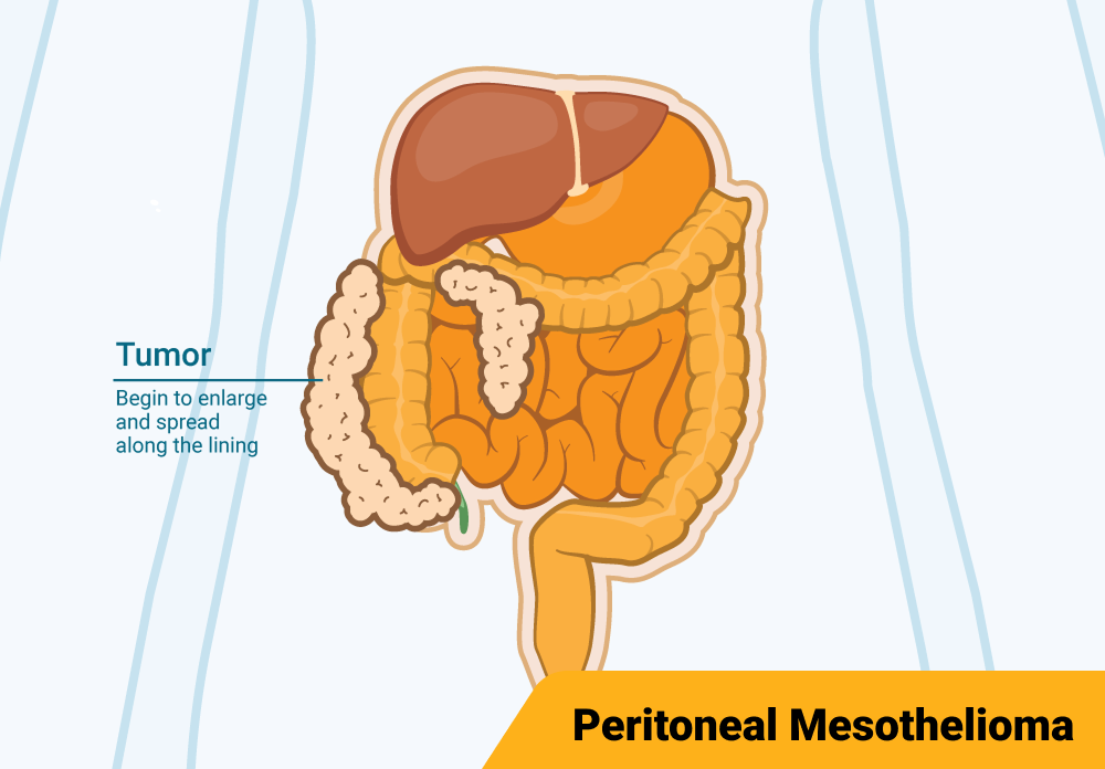 Diagram illustrating Stage 2 peritoneal mesothelioma affecting the peritoneum and a small part of the abdomen