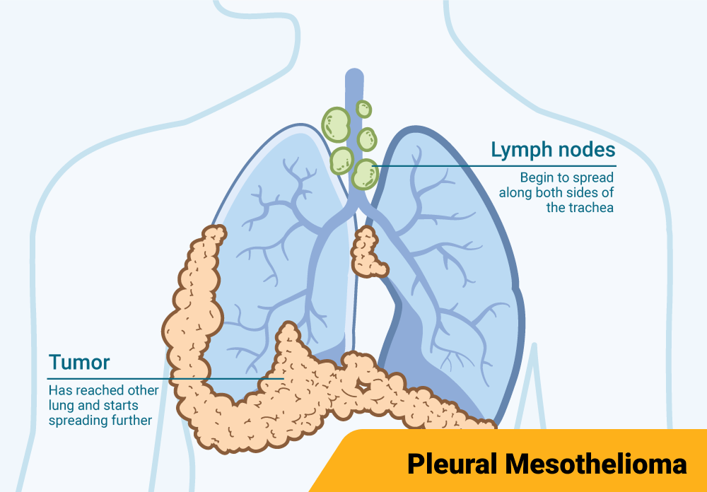 Diagram illustrating stage 4 pleural mesothelioma, highlighting the pleura between the lung and chest wall.