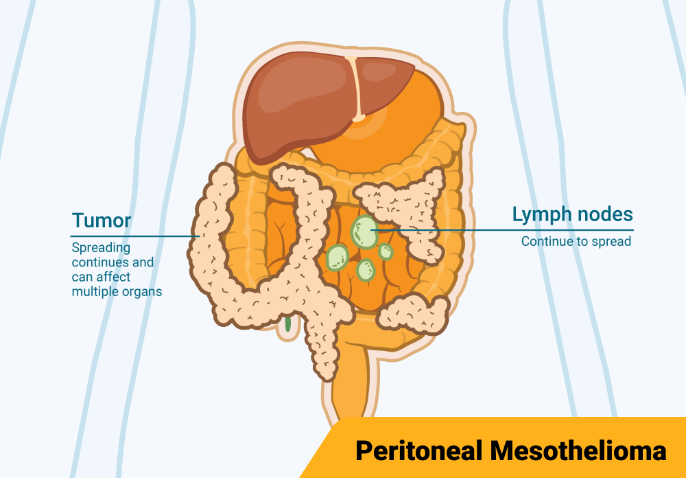 Diagram illustrating Stage 4 peritoneal mesothelioma affecting the peritoneum and a small part of the abdomen