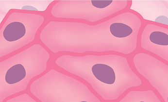 Epithelioid mesothelioma tumor cells