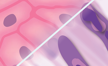 Biphasic mesothelioma tumor cells