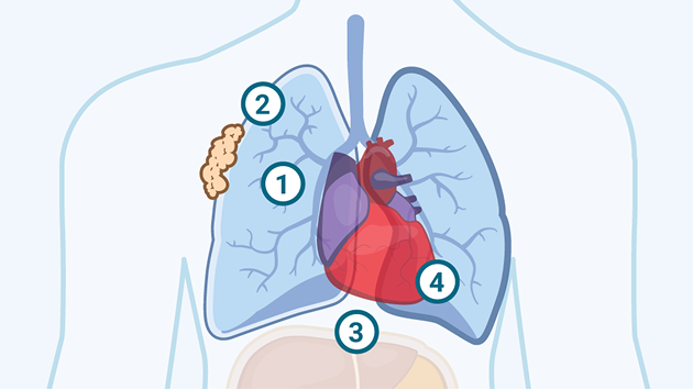 Targeted Sites During an EPP Procedure